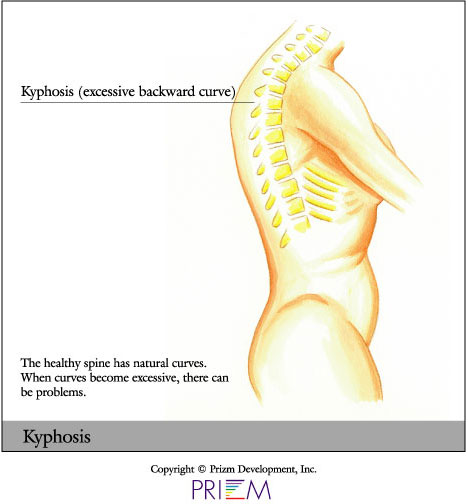 Home Remedies for Curvature